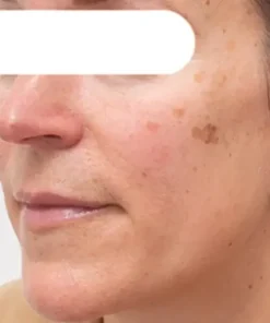 Cheemex® Herbal Spots Peel-Off Facial Mask