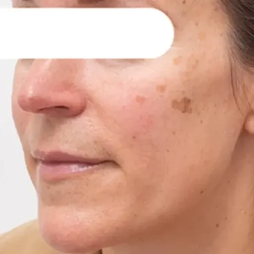 Cheemex® Herbal Spots Peel-Off Facial Mask