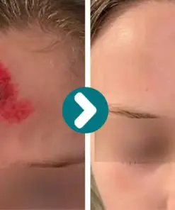 Cheemex® SKINSHIELD QUICKDRYING LIQUID BANDAGE