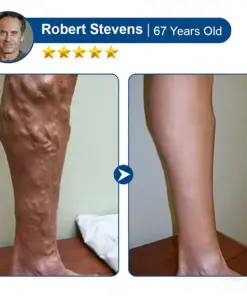 Cheemex® Vein Contour Microneedle Patch