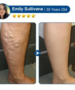 Cheemex® Vein Contour Microneedle Patch