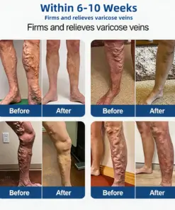 Cheemex® Vein Contour Microneedle Patch